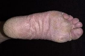 Признаци и симптоми на гъбички по краката