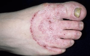 Причините за появата на гъбичките на краката