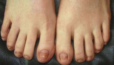 Етапи на развитие на гъбички за нокти