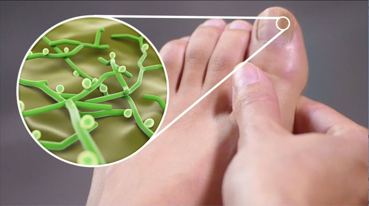 патогени на гъбички по ноктите на краката