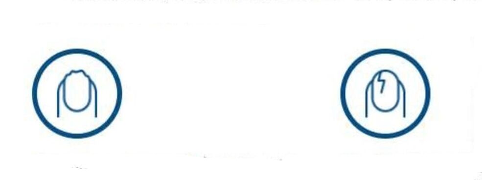 деформация на ноктите поради гъбична инфекция