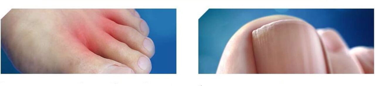 начален стадий на гъбички по краката